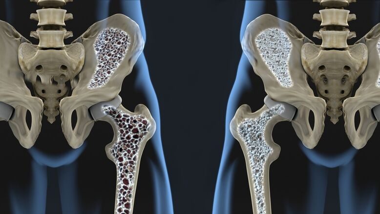 Osteoporosis: prevención y detección